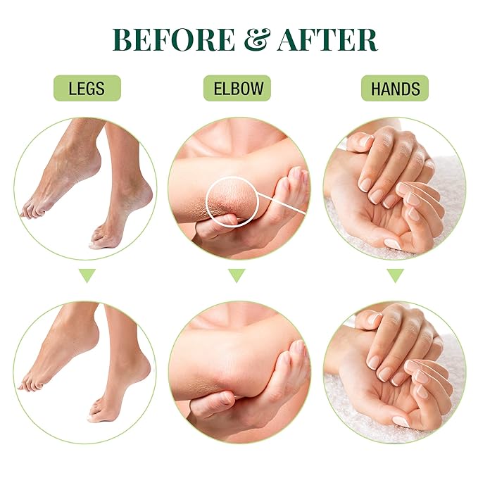 Comparison of legs, elbows, and hands before and after skincare treatment for smoother, healthier skin.